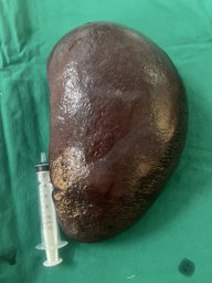 Hình ảnh chi tiết tin tức Phẫu thuật cách Lách "khủng" 2kg cho bệnh nhi 12 tuổi mắc bệnh thiếu máu huyết tán Hình ảnh tin tức Phẫu thuật cách Lách "khủng" 2kg cho bệnh nhi 12 tuổi mắc bệnh thiếu máu huyết tán